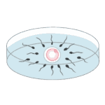 受精(媒精)- 体外受精(IVF)