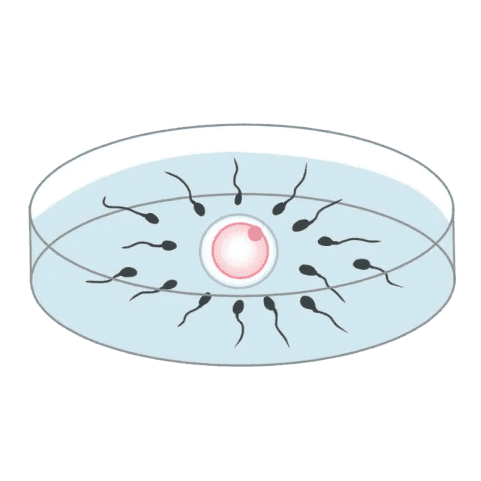 受精(媒精)- 体外受精(IVF)
