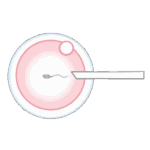 受精(媒精)- 顕微授精(ICSI)