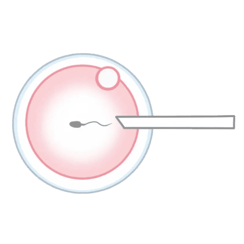 受精(媒精)- 顕微授精(ICSI)